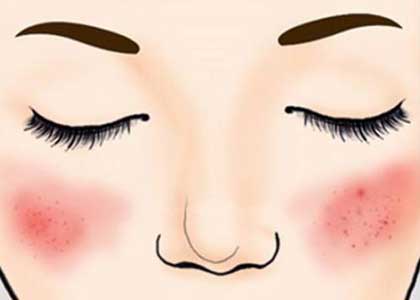 上海按摩网告诉你秋季脸部出现红血丝怎么处理